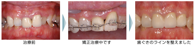 矯正治療＋歯ぐきのライン修正