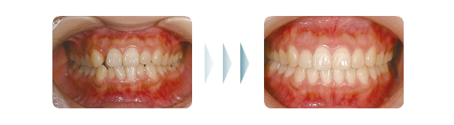 歯列矯正の治療例001