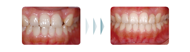 歯列矯正の治療例002