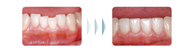 歯列矯正の治療例003