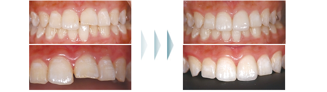 ラミネートべニアの治療例01