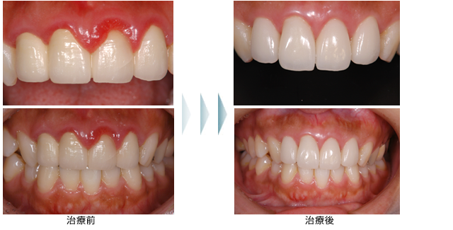症例1　オールセラミックにて治療