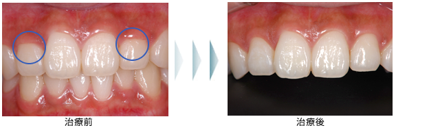 症例2　歯茎の審美治療