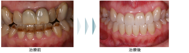 症例3　歯科恐怖症の方の審美治療
